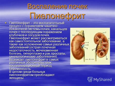 Презентация на тему: "Воспаление почек Пиелонефрит Пиелонефрит – это ...