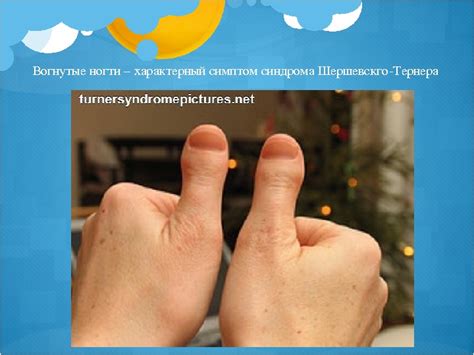 Презентация Синдром Шерешевского-Тернера