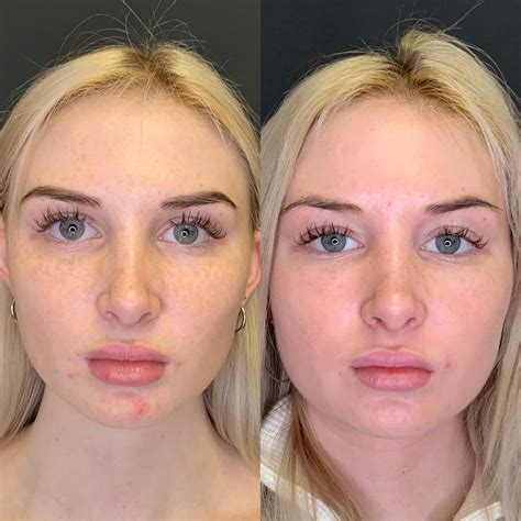 The Magic of PRP: Before And After - Beauty Boost Med Spa