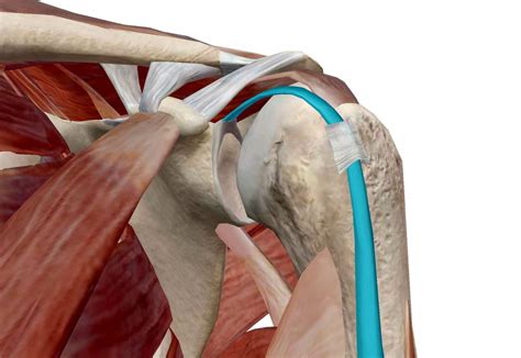 Tendinitis Bicipital: Meaning, Warning Signs And Treatment