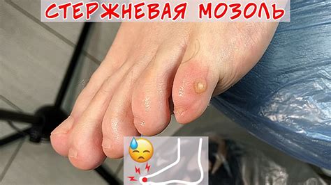 Удаление стрежневой мозоли на мизинце - YouTube