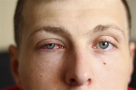 Headache Making Eyes Feel Swollen at Shawn Velasquez blog