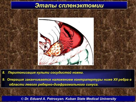Операции на селезенке - презентация онлайн