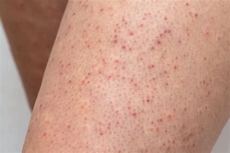 How to Get Rid of Chicken Skin (Keratosis Pilaris) - Riverchase Dermatology