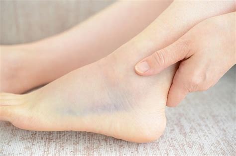 Вывихи стопы: виды, симптомы, первая помощь и лечение: статьи клиники ...