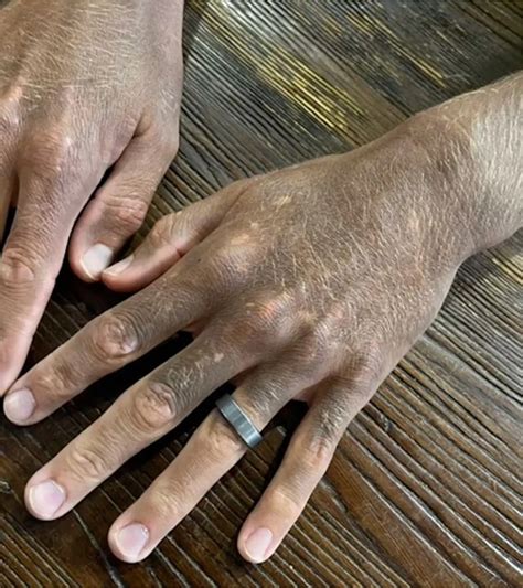 Man Goes Viral After Skin Changes Color While on Antidepressant—See