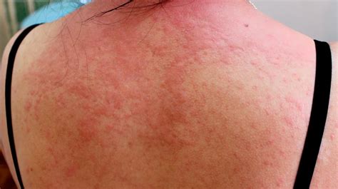 treatment  skin irritation