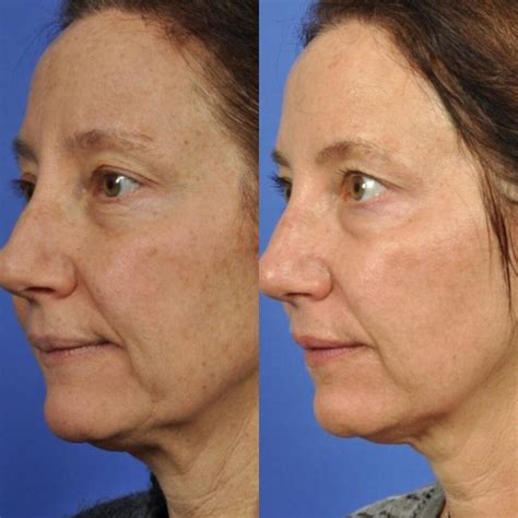 microneedling    wrinkles   difference