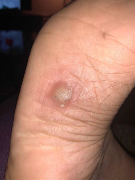 Plantar callus? Wart? Help please! It gets like this when I pull at it