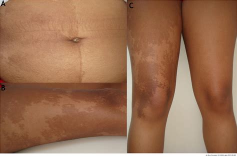 McCune-Albright syndrome – A case report with transmission electron