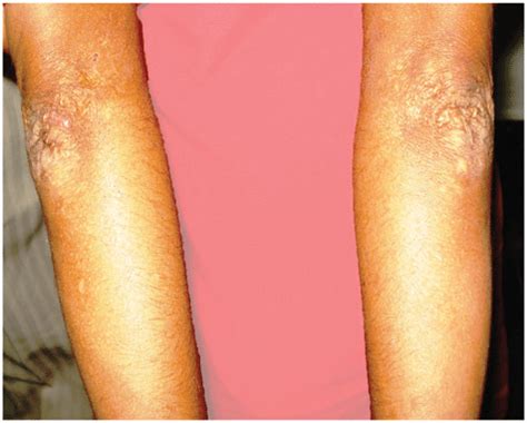 multiple atrophic scars    extensor surface  forearm