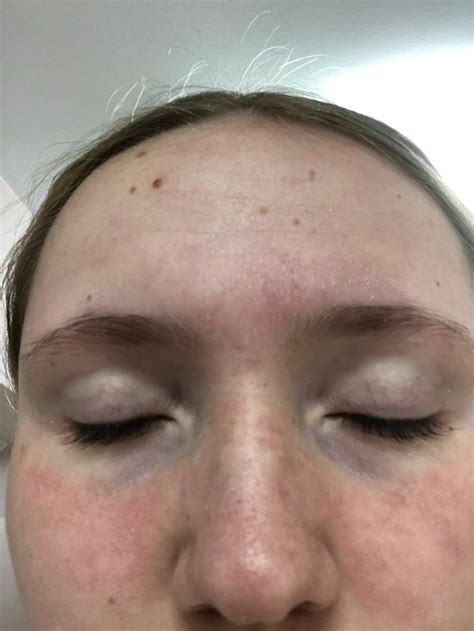 Trockene Haut und rote Flecken im Gesicht nach duschen? (Gesundheit und