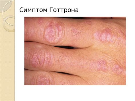 Дерматомиозит - презентация онлайн