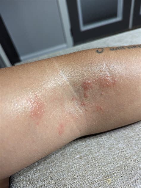 Random rash or reaction on skin. What is it? : r/AskMedical