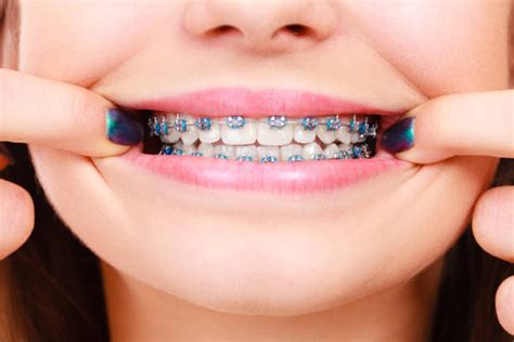 Do Braces Hurt: When You Get Them Off and When Tightened? | The