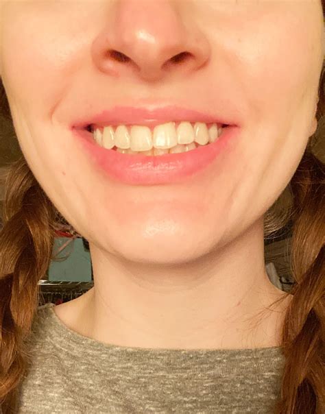 I tried microneedling to plump my lips – it costs less than fillers but