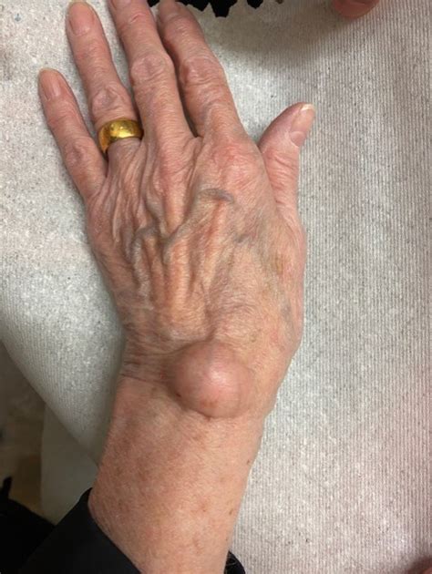 Hand and wrist swelling: an expert's guide | Top Doctors