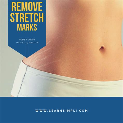 Remove Stretch marks in minutes, instantly at home