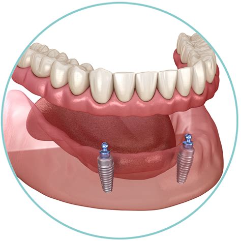 Dentures Vs Implants | Richmond, VA | Advanced Dental Care