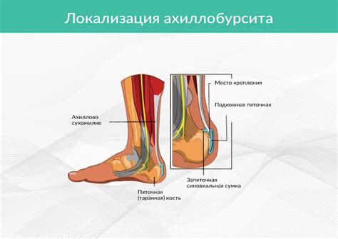 ᐈ Заболевания Ахиллова сухожилия ~【Лечение в Москве】