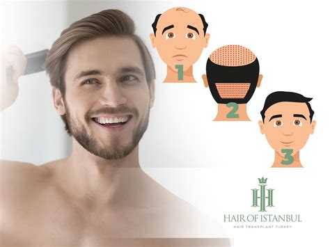 Hair Transplant Recovery Timeline – Complete 2025 Guide