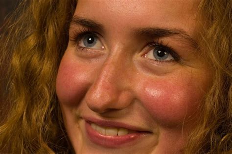 When Skin Redness Isn’t Rosacea By LAB Skin Clinic
