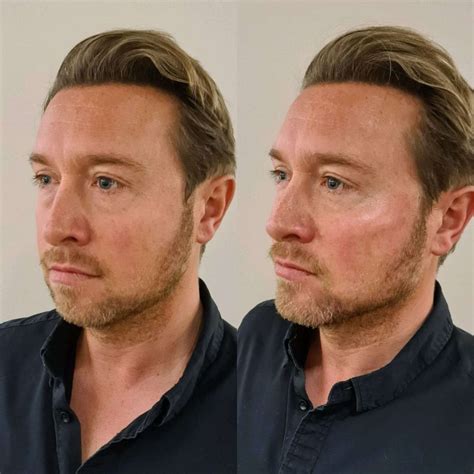 Derma Medical Full Facial Transformation Masterclass - Derma Medical