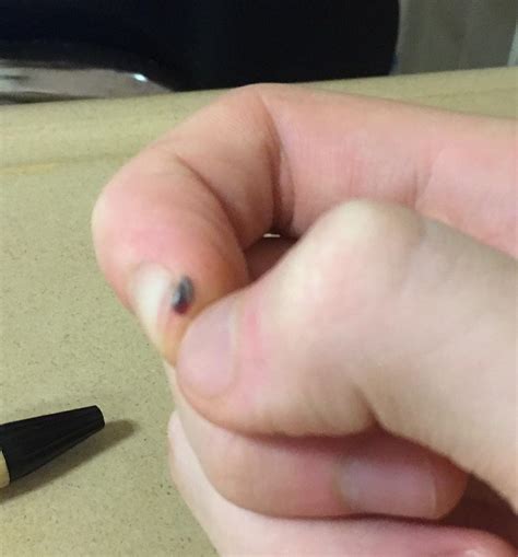 My finger started bleeding under my skin : r/mildlyinteresting