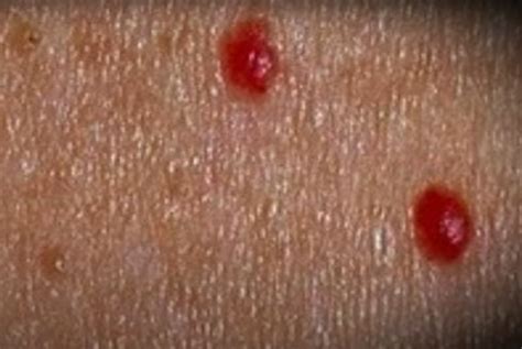 Bolha De Sangue Na Pele - Pintas vermelhas na pele: o que são, causas e como tirar