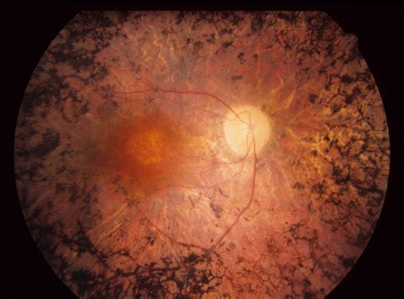 Retinitis Pigmentosa - Ophthalmology Education - blog - Retinitis ...