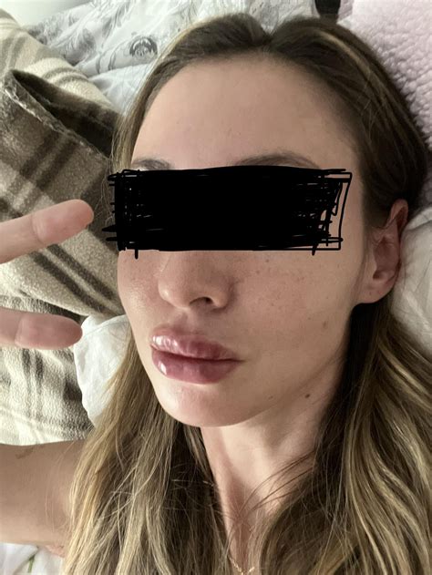 My Own Botched Experience : r/Botchedsurgeries