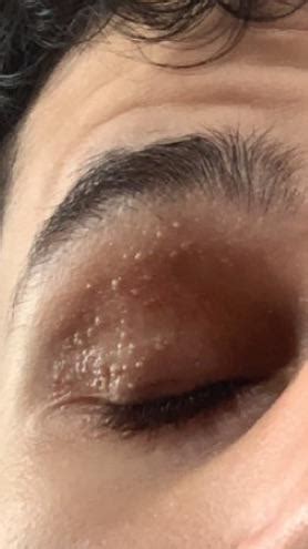 White dots on eyelid : r/SkincareAddicts