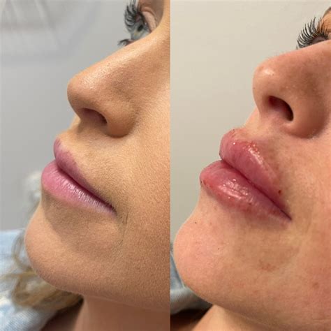 Fillers Before And After | Roots Wellness And Med Spa