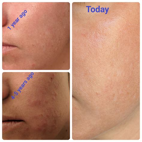 365 best Salicylic images on Pholder | Warts, Skincare Addiction and