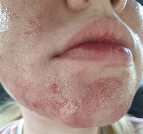 Skin Yeast Fungal Infection