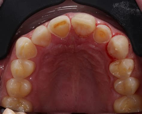 Figure 8 - moving onto to occlusal view alternate tooth build up