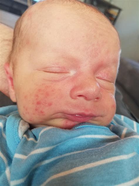how to help baby acne 5