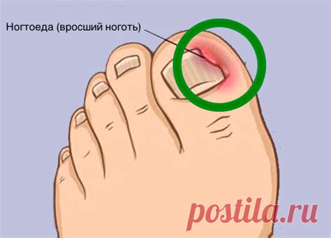 Как правильно решить проблему вросших ногтей и что такое ногтоеда ...