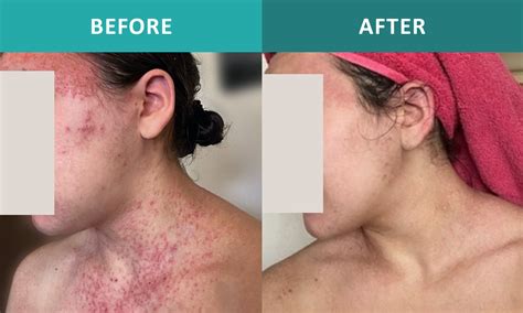 Natural Treatment for Rashes | Dermatologist Los Angeles