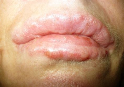 Swollen Bump On Lip | Images and Photos finder