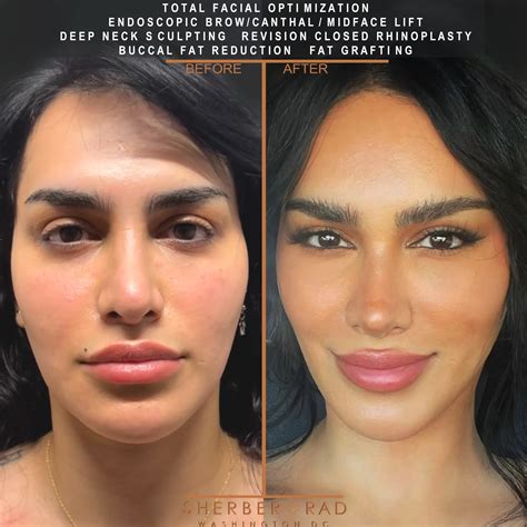 Facial Masculinization in Washington DC | Sherber + Rad