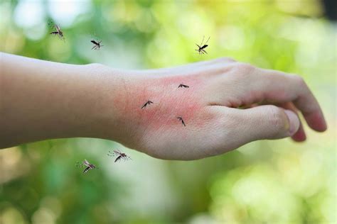 Types Of Mosquito Bites at Guillermo Odea blog