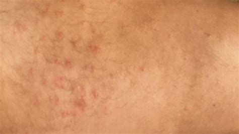 Manchas No Corpo O Que Pode Ser