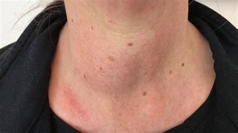Thyroid Nodules