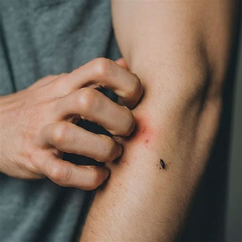 Can Bed Bugs Survive Plane Rides at Audrey Stier blog