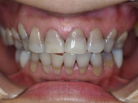 Composite Fillings - Before & After Pictures | The Favour Dental