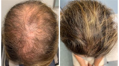 bcaa side effects hair loss 2