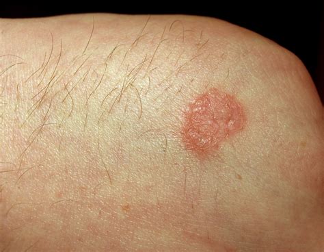 Hautpilz Trockene Füße Haut Löst Sich