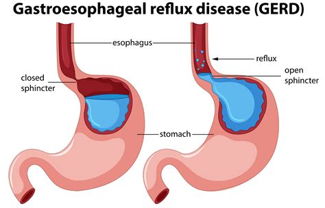 acid reflux gerd dr ram chandra soni