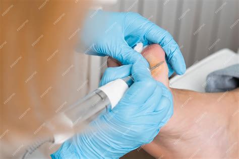 Como Tirar Um Calo Do Dedo Do Pé - Podologista remove um calço no dedo do pé de um paciente | Foto Premium